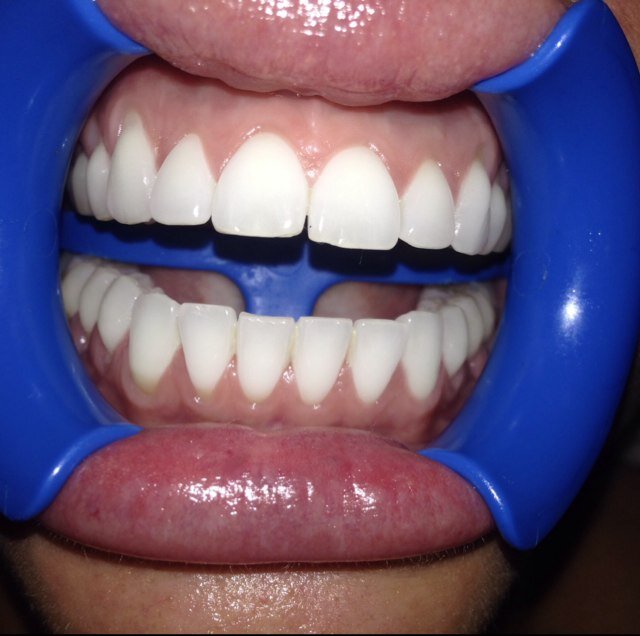 Email teeth_whitening@outlook.com for more info! Beautiful white teeth in a quick and painfree session. Everyone deserves a hollywood smile