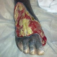 London Diabetic Foot (@londondfn) 's Twitter Profile