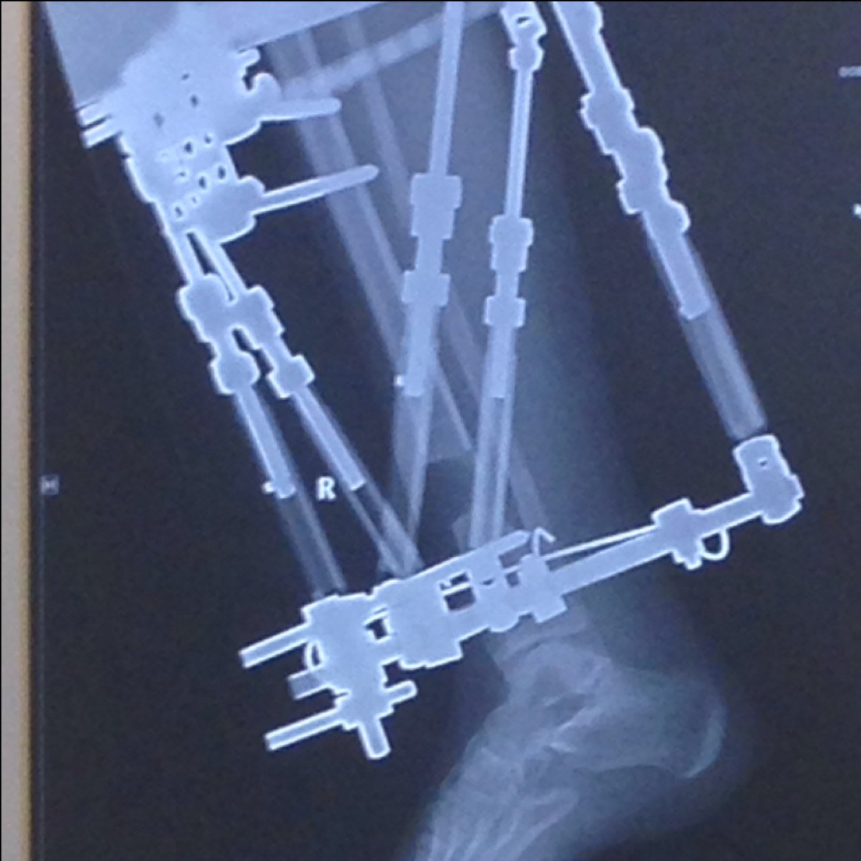 XternalFixature's profile picture. Hi! Im a student who will be researching and sharing information about the taylor spatial frame. I am currently going through the procedure.