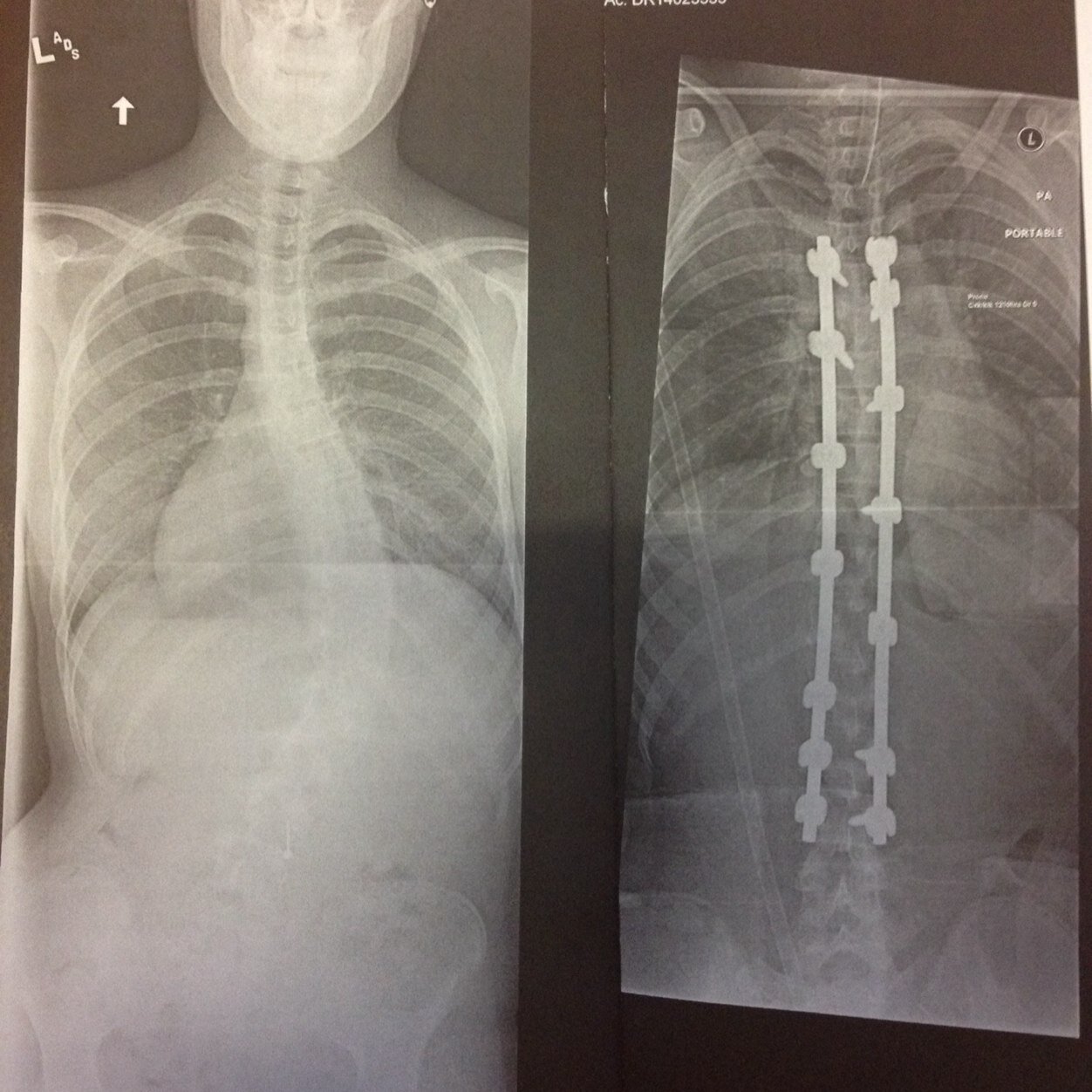 Was diagnosed with scoliosis @ 13 yrs old. Wore a brace for a year and a half. Got surgery January 28th 2014. Feel free to message me with questions or anything