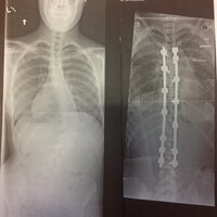 Scoliosis Life⚓ (@bentnotbroken45) 's Twitter Profile