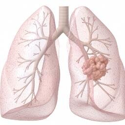 Lung Cancer News