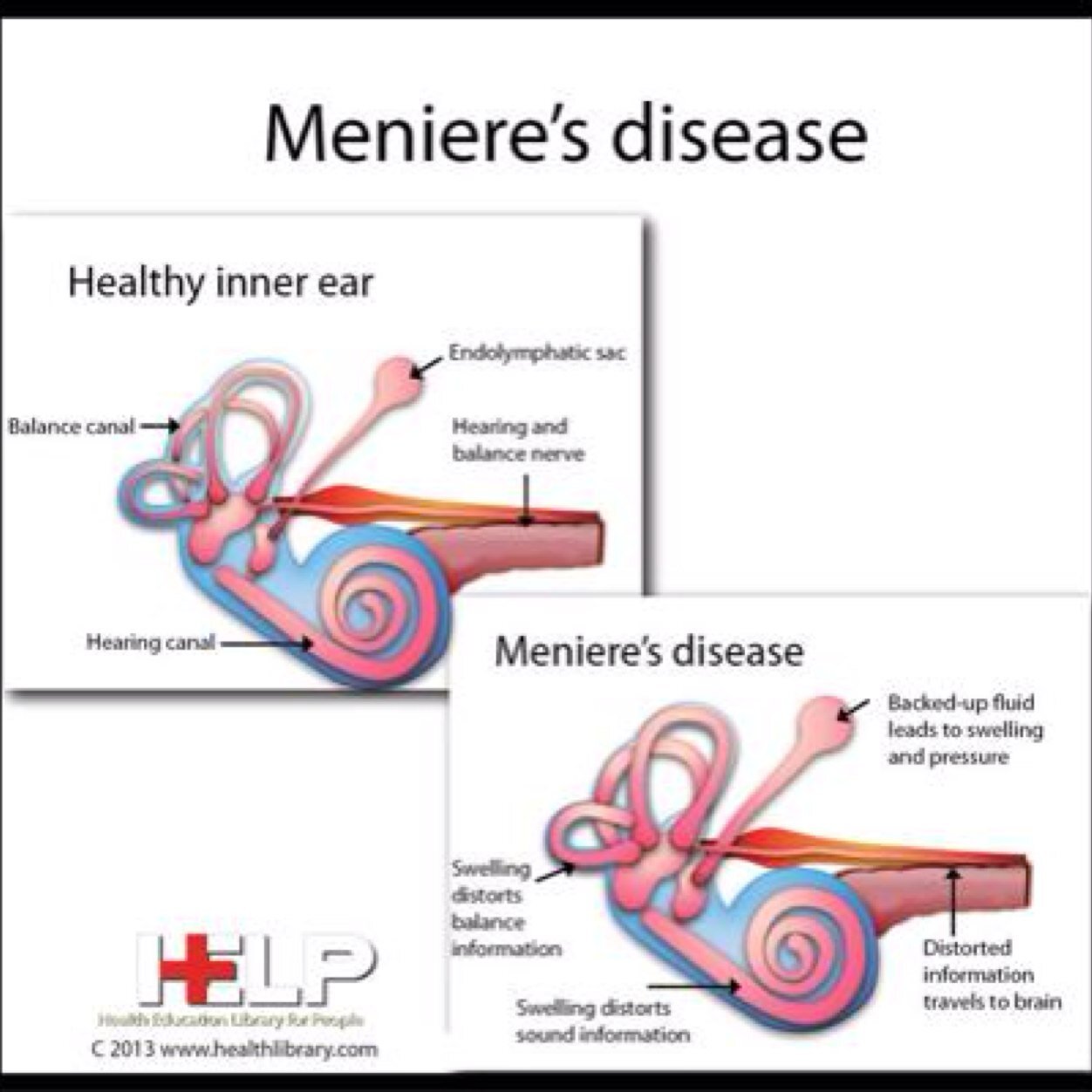 A syndrome in which you experience vertigo, hearing loss, and ringing in the ear.