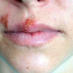herpesphotos's profile picture. visit our site http://t.co/1DEjxxpmva for more information on What Does Herpes Look Like.