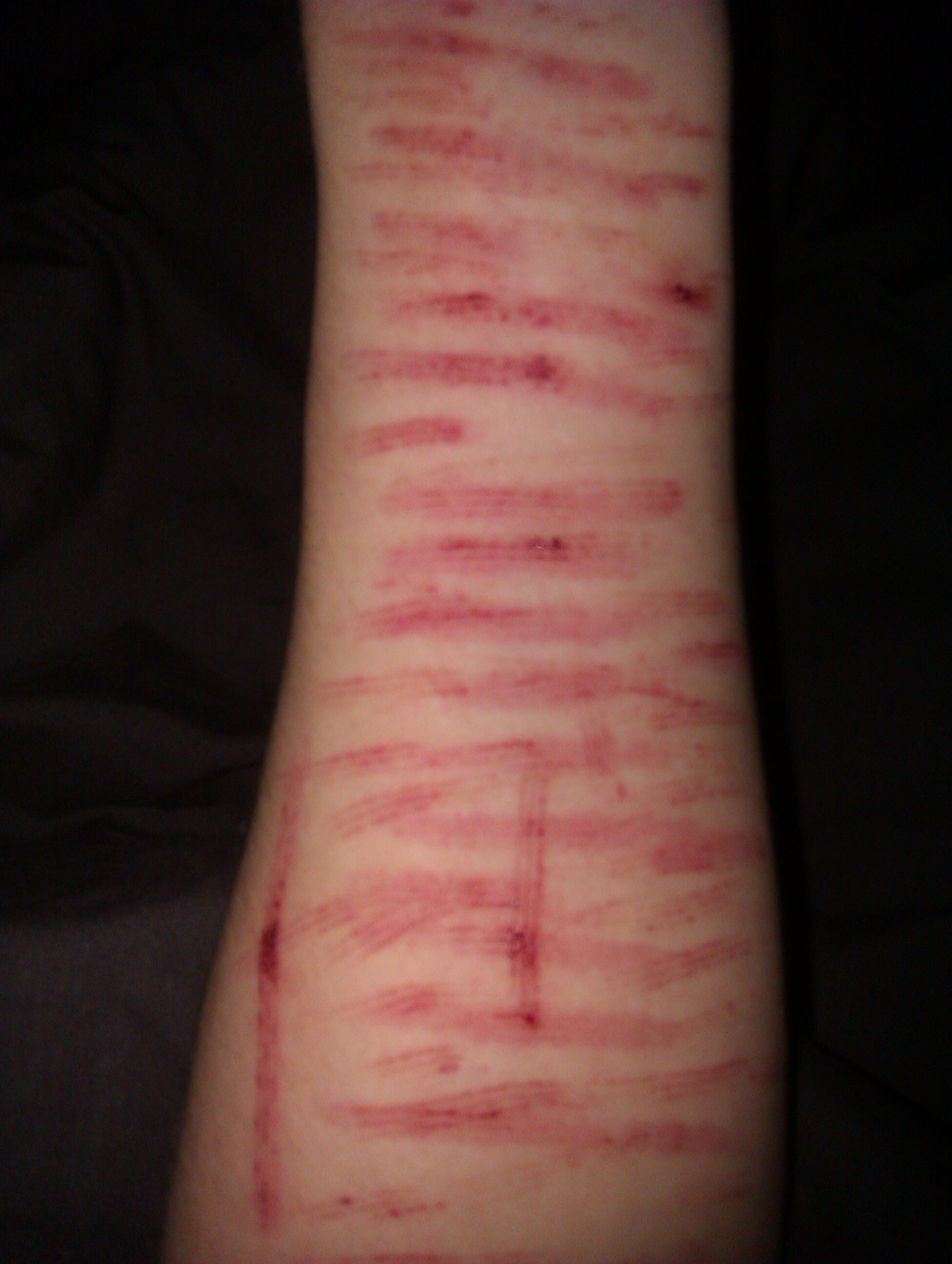 Depression, bulimia, Self Harm, Anxiety, Suicidal Thoughts/Actions, Anger Issues