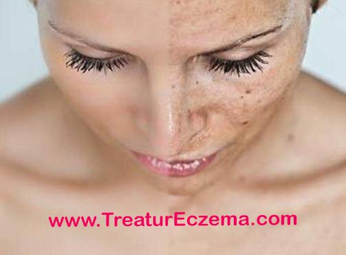 TreatmentEczema's profile picture. If you've got eczema it's likely that you've got questions. I'm here to share methods that help prevent or even cure eczema.
http://t.co/qrTXtSrCIf