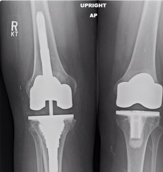 University of Michigan; retired orthopedic surgeon; knee and hip replacements;
