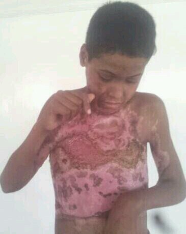 الله يوفقكم ساعدوني كي اسوي عمليات لاخوي رقبته التصقت بفكه السفلي ولايرفع راسه ولا يمد يداته.للتواصل عبرالواتساب 0538877972 اواتصال على رقم+967735074485