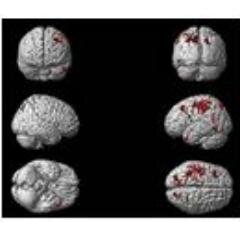 Using the MentScan to image neurologic disease, thoughts and memory