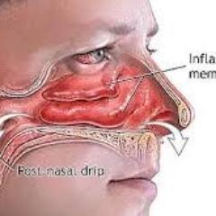 Everything you need to know about sinus infection symptoms. Sinus is a common infection and thousands of people suffer it every day without knowing about actual