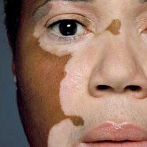 A man struggling to come to terms with his 'vitiligo' finds the courage to live in his own skin again.