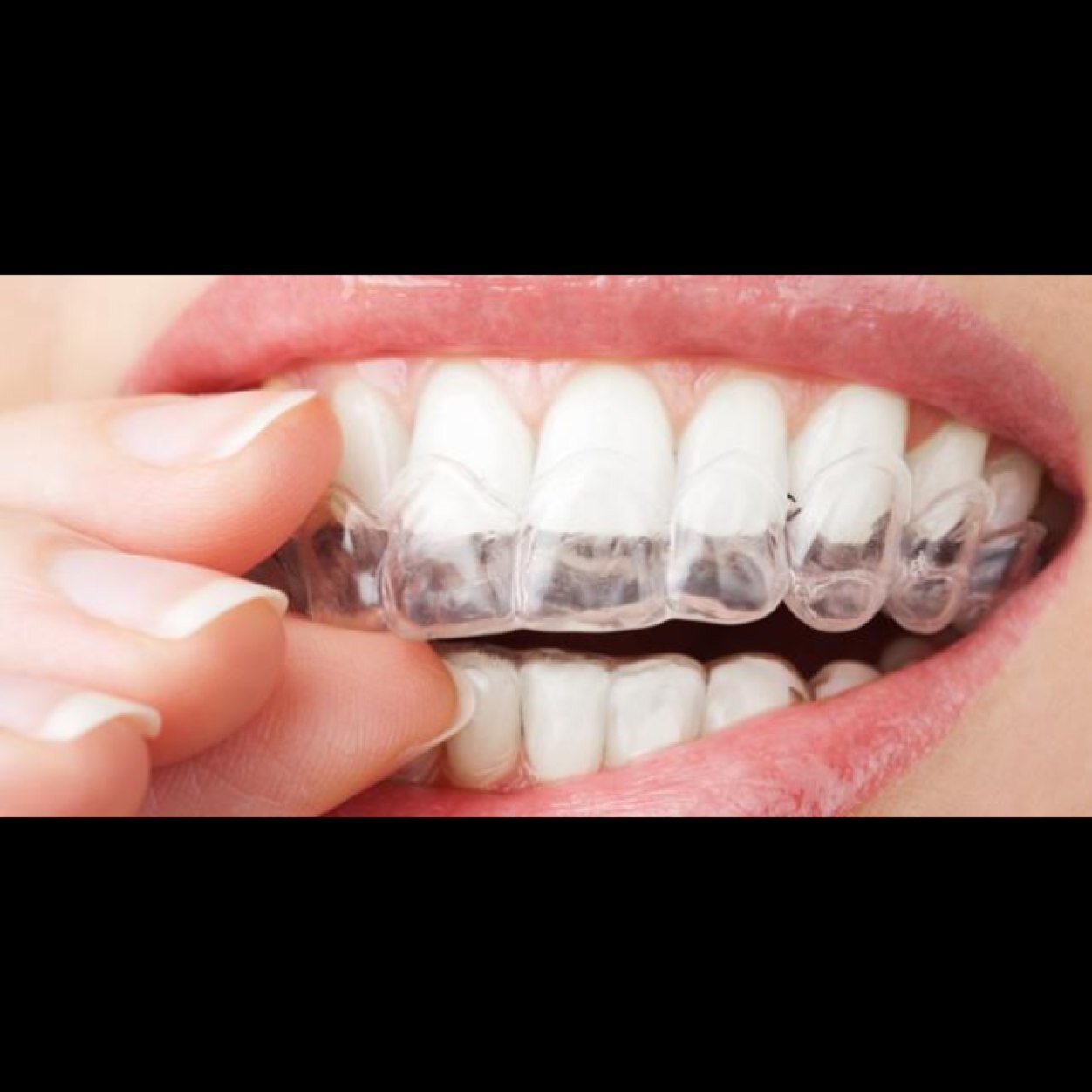 Theres nothing more attractive than a bright white smile! Wonderfullywhiteteeth@hotmail.com