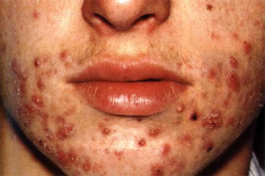 Anti-asepxia