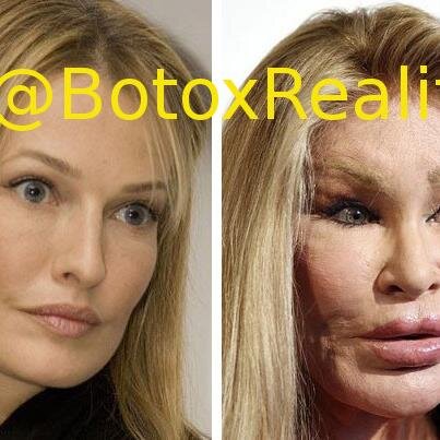 Hollwyood: STOP #injecting your lips & faces with #Botox and #Restylane. #BotoxReality