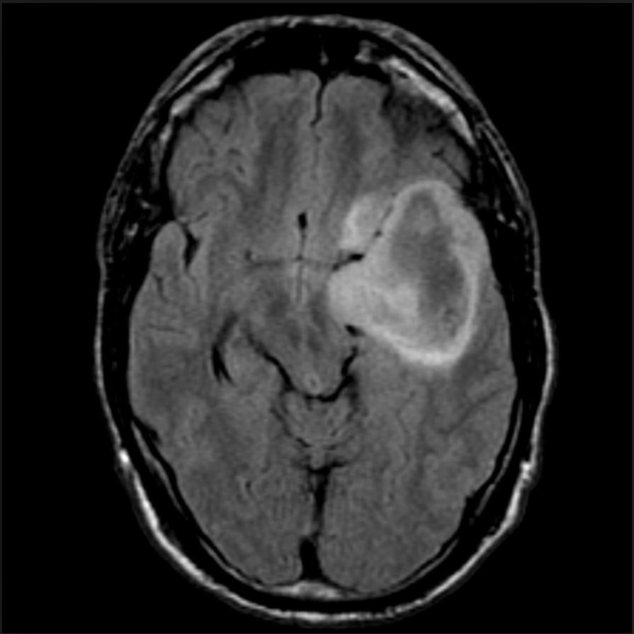 astrocytoma facts astrocytomaf twitter