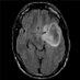 Astrocytoma Facts (@astrocytomaf) Twitter profile photo Astrocytoma Facts (@astrocytomaf) Twitter profile photo