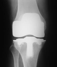 An evidence driven, total joint care program with a focus on Lean processes designed to reduce costs, increase revenues, and improve outcome measures.