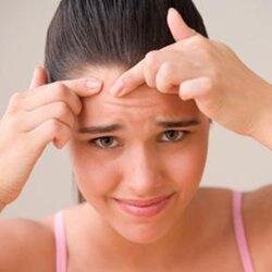 How To Get Rid Of Acne