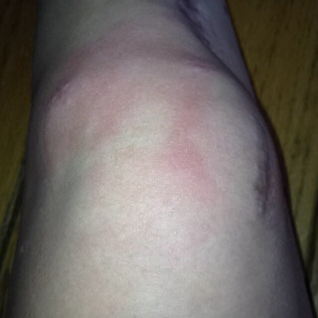 everything & anything knee injury related
