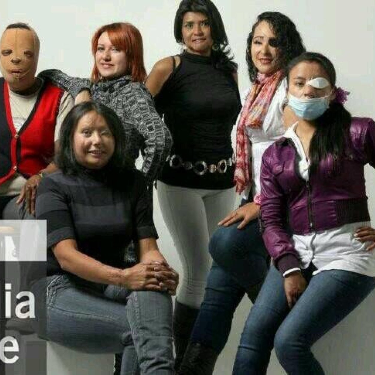 Fundación ReconstruyendoRostros nace de la más dolorosa experiencia de Gina Potes. Primera victima con agentes quimicos en Colombia. 
Una cicat