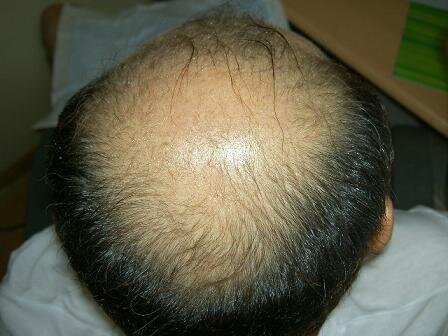 hagechiryo's profile picture. ２８歳の元ハゲ野郎です。元ハゲなのは実は自毛植毛をしたのと、魔法の薬であるプロペシアで維持してるからだよ。まあその辺はこのサイトを見てもらえれば包み隠さず書いてます。