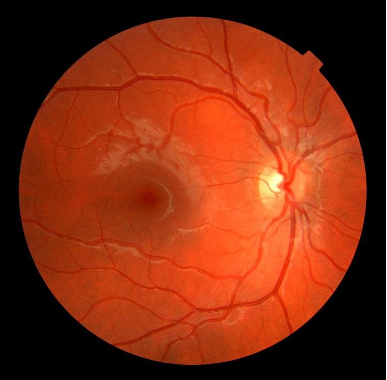 Optometrista, Cuidado Primario de Salud Visual, Contactólogo, Queratocono.