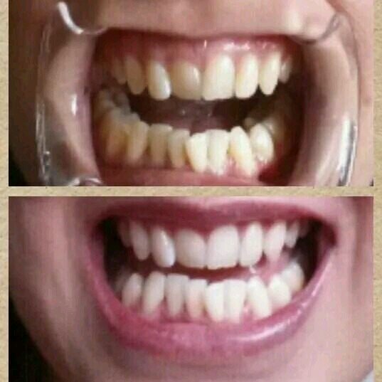 Cosmetic Teeth Whitening East London & Essex