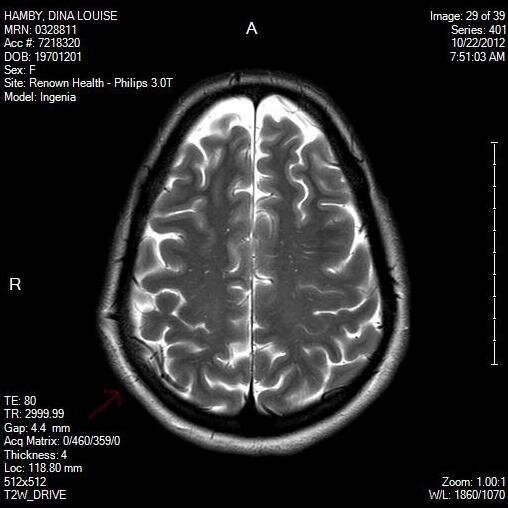 Hi, I am Ti  please tell me what you see in the leftside of my brain on the Mri. My ex-boyfriend Chuck put this microchip in me in 2009 without my consent.