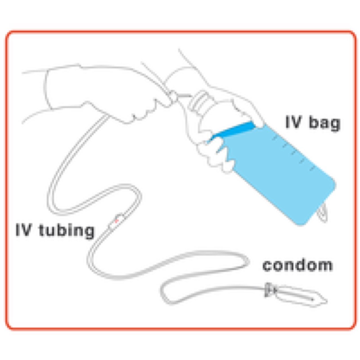 Reducing postpartum hemorrhage with the Intrauterine / Condom Balloon Tamponade (CBT) #innovation. Method by Dr. Akhter. Eng, Fr. @Mtnva_Research @maternova