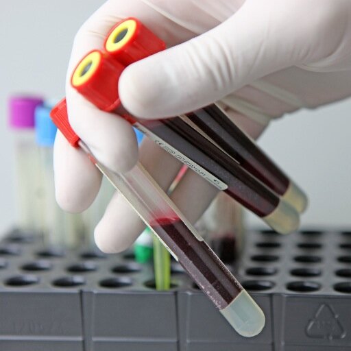 Clinical Diagnostic Laboratory offers a comprehensive range of laboratory tests to support physicians, hospitals, Nursing Homes.