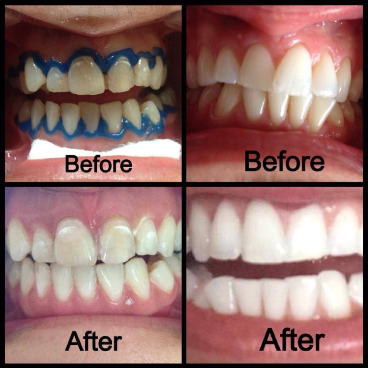 LilyWhiteLaser's profile picture. Lilly White Laser Teeth Whitening Mobile 8 Years Experience as a Dental Nurse
Contact Number 07779362352