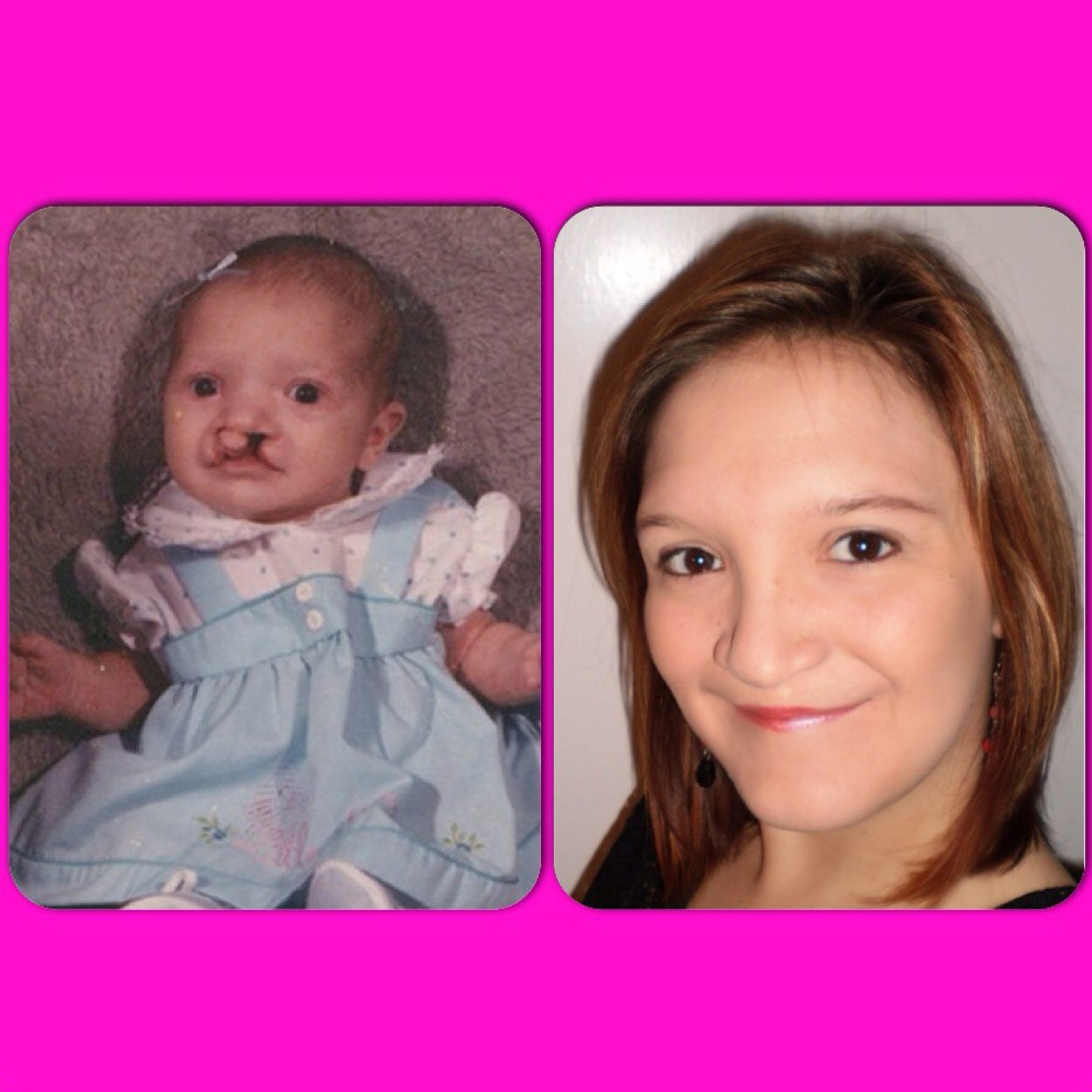A cleft kid loving life and all of its possibilities!