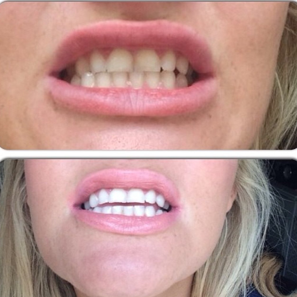 **Mobile Teeth Whitening** Harley Street Qualified Kent, South East London, Essex