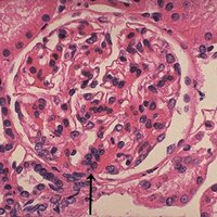 nephro news (@nephropathyiga) 's Twitter Profile