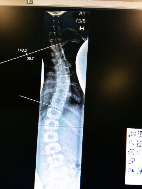 47° curve • providence brace • no surgery yet