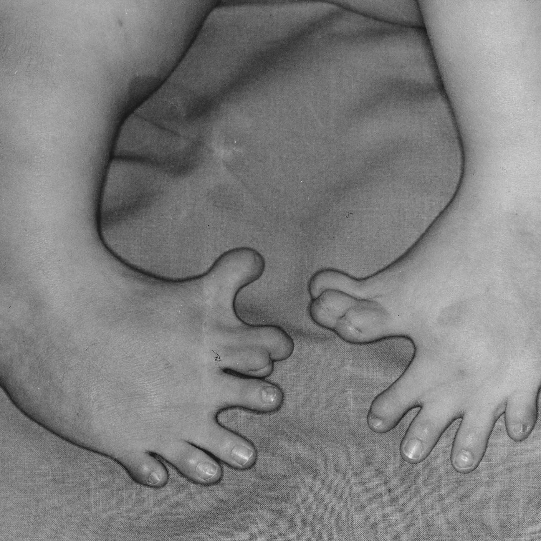 Official site run by the Thalidomide survivors campaign, to get support from German government for unmet health needs to counteract rapidly deteriorating health