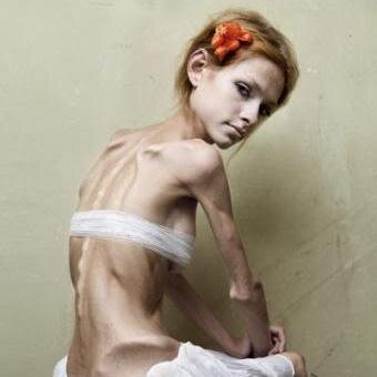 ...Lysa... ||19 años|| Anorexia desde los 14.