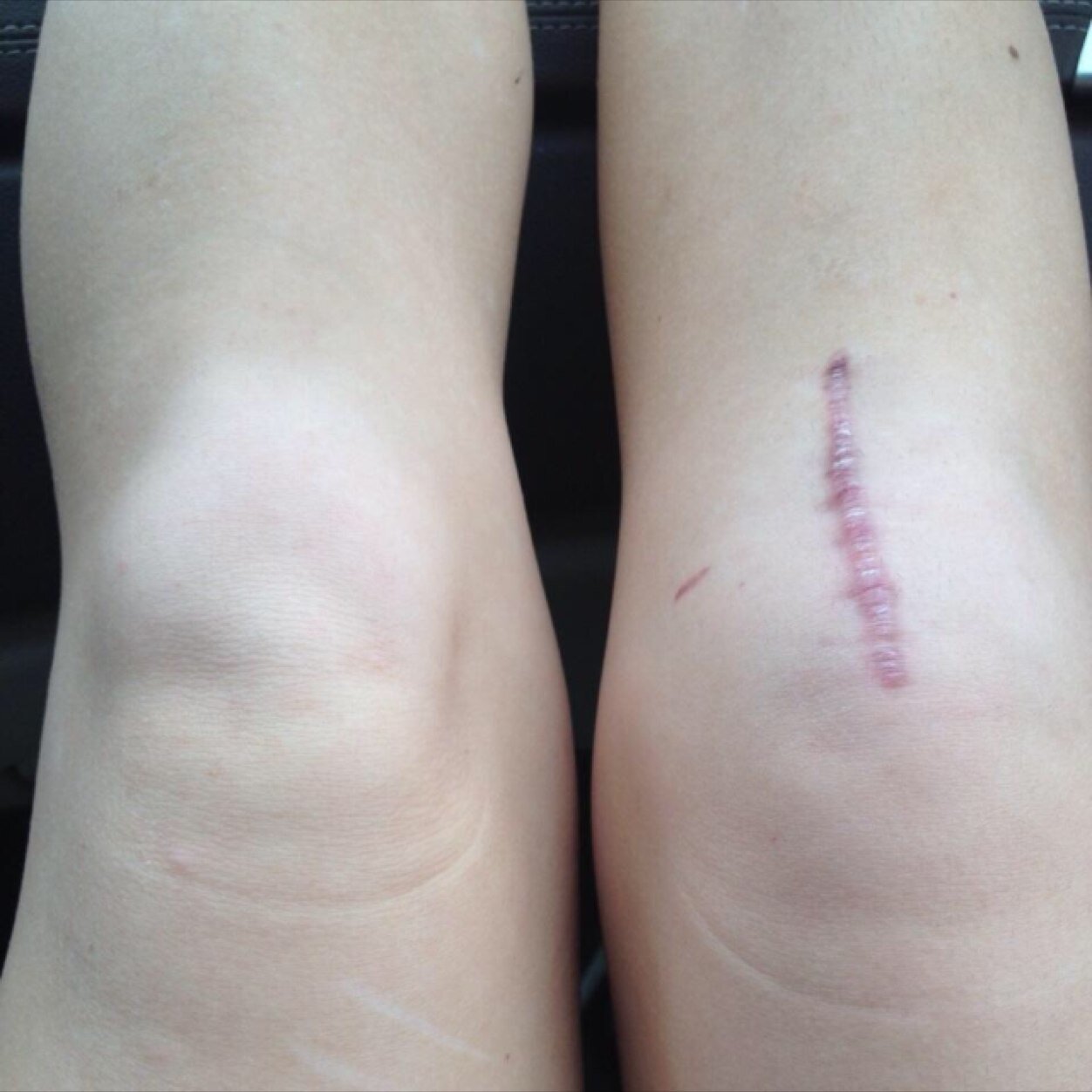 |Just an athlete recovering from an ACL and meniscus tear, hoping to get others through it| |cheerleading and track| |This isnt the end, its only the begining|