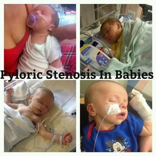 Pyl0ricStenosis's profile picture. Pyloric stenosis in babies is very common but no one has ever heard of it, we need to make it more aware