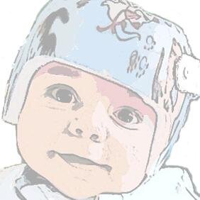 Raising awareness about Plageocephaly in babies