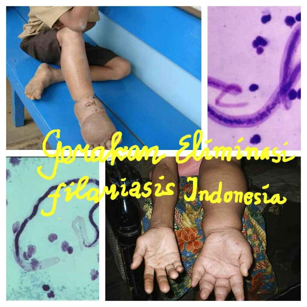 Gerakan Eliminasi Filariasis & Pengendalian Kecacingan Indonesia