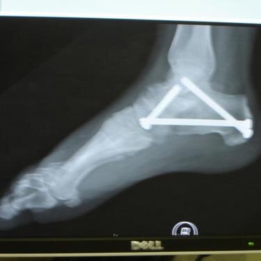 I have a bionic foot. it will kick your ass.