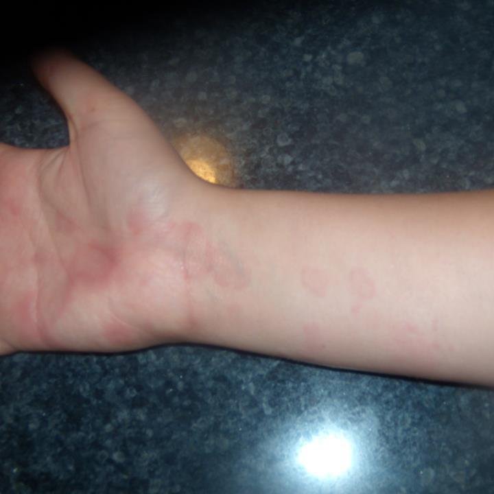 gardasilinjured's profile picture. My daughter had 3 Gardasil shots and developed -blistering rash, hives, wheals, joint pain, angioedema, headache, nausea, vomiting, fatigue.