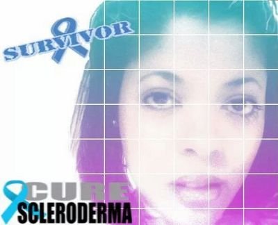SCLERODERMA SURVIVOR :)