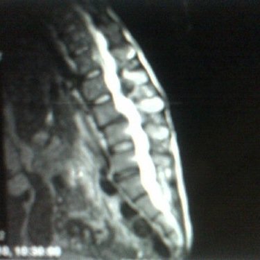 2 x Olympian who has suffered fractures, ruptured discs & 24/7 PAIN!