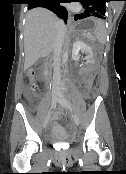 Trauma and Urologic Reconstruction Network of Surgeons | National Collaborative for Genitourinary #trauma #urethralstricture #radiationinjury #maleincontinence