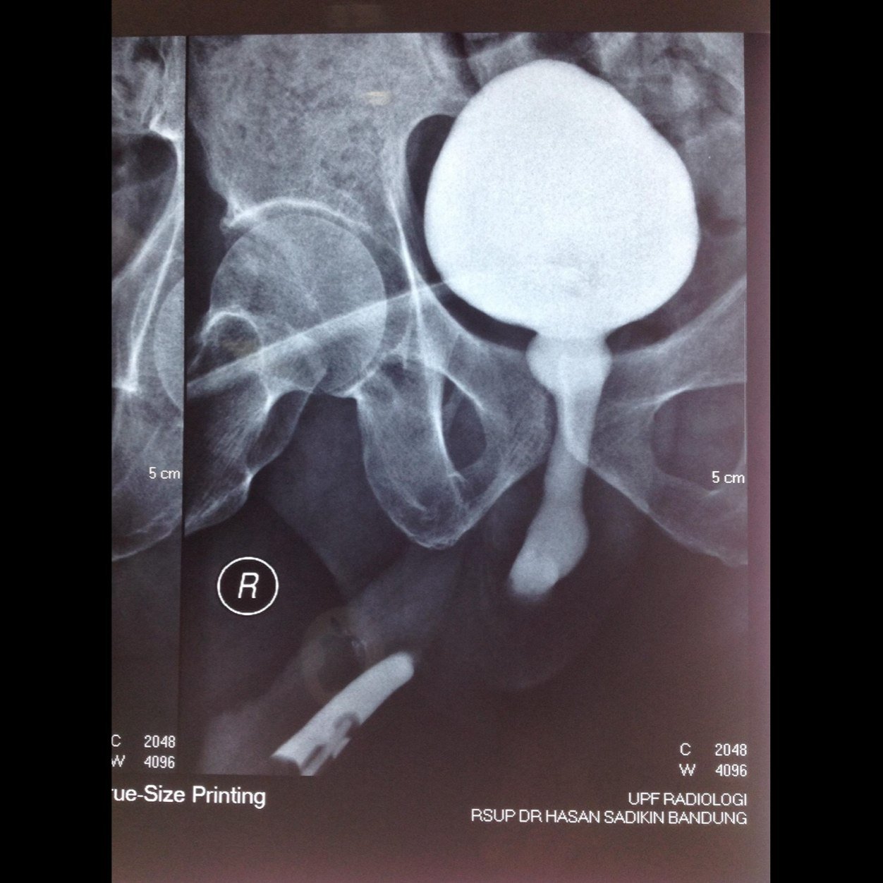 InaGURS (Indonesian GenitoUrinary Reconstructive Section). Urologist at Melinda 2 hospital, RSHS, RS santosa Bandung, Indonesia