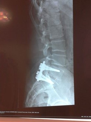 alexgdb's profile picture. unos tornillos en mi espalda...nunca me impediran disfrutar de hacer deporte..