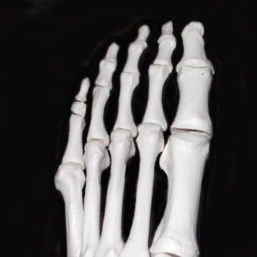 NHS & private foot surgery. Manchester, Euxton (Chorley), Preston, Blackpool & Lytham St Annes, Lancs. Consultant Podiatric Surgeon at Blackpool NHS