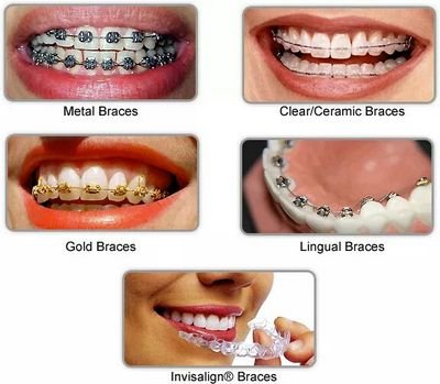 Dr.Mathesul's Speciality Invisible Braces Orthodontic Dental clinic. Invisalign,Damon USA Braces,Clearpath orthodontics, sms 8983101099